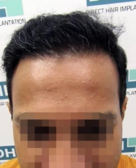 After DHI hair transplant