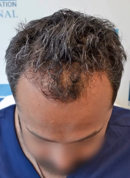 Before DHI hair transplant