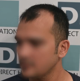 Before DHI hair transplant