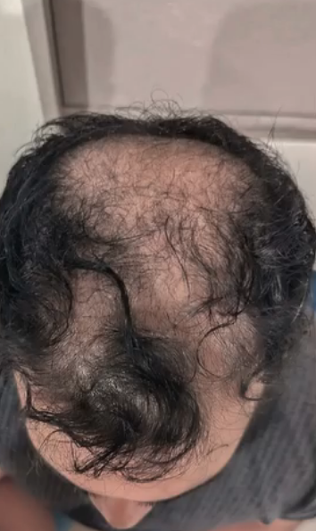 Before DHI hair transplant