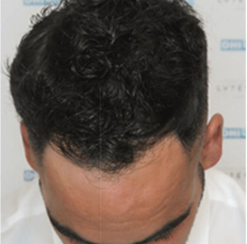 After DHI hair transplant