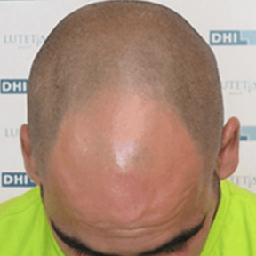 Before DHI hair transplant