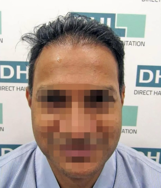 Before DHI hair transplant