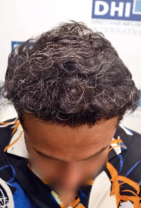 After DHI hair transplant
