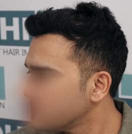 After DHI hair transplant
