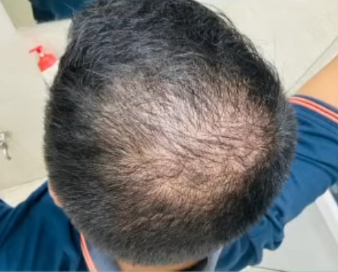 Before DHI hair transplant