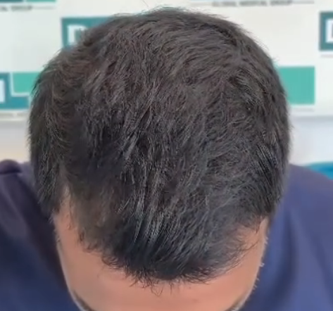 After DHI hair transplant