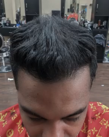 After DHI hair transplant